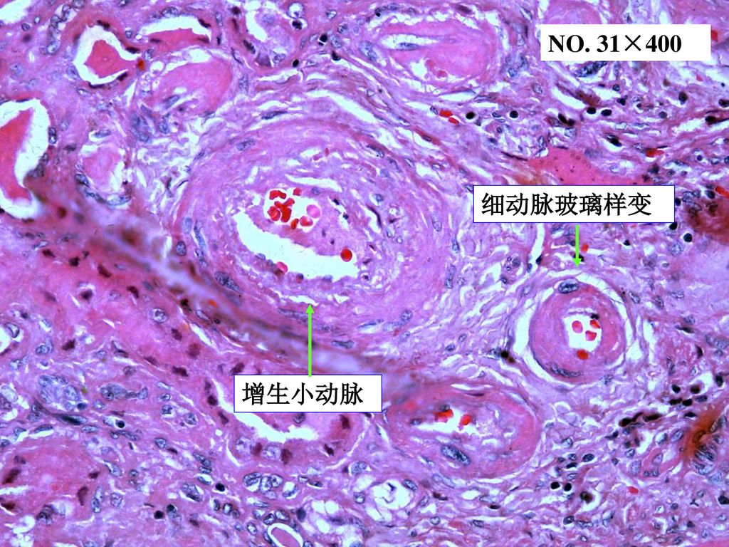 原发性颗粒性固缩肾 no 31×400细动脉玻璃样变增生小动脉 no.